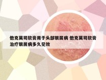 他克莫司软膏用于头部银屑病 他克莫司软膏治疗银屑病多久见效
