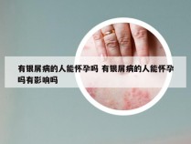 有银屑病的人能怀孕吗 有银屑病的人能怀孕吗有影响吗