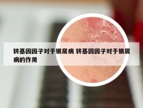 转基因因子对于银屑病 转基因因子对于银屑病的作用