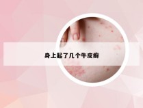 身上起了几个牛皮癣