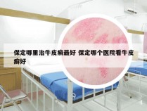 保定哪里治牛皮癣最好 保定哪个医院看牛皮癣好