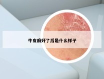 牛皮癣好了后是什么样子