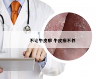 不让牛皮癣 牛皮癣不养