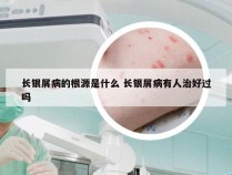 长银屑病的根源是什么 长银屑病有人治好过吗