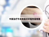 中国治疗牛皮癣最好的医院是哪里