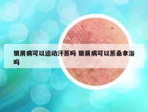 银屑病可以运动汗蒸吗 银屑病可以蒸桑拿浴吗