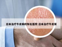 日本治疗牛皮癣的知名医院 日本治疗牛皮屑