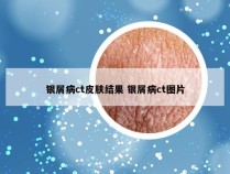 银屑病ct皮肤结果 银屑病ct图片