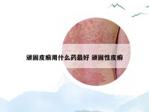 顽固皮癣用什么药最好 顽固性皮癣