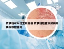 皮肤镜可以检查银屑病 皮肤镜检查银屑病需要皮损检查吗