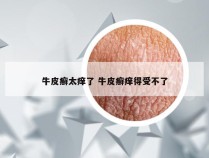 牛皮癣太痒了 牛皮癣痒得受不了