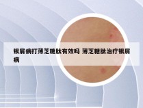 银屑病打薄芝糖肽有效吗 薄芝糖肽治疗银屑病