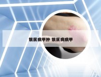 银屑病甲肿 银屑病病甲