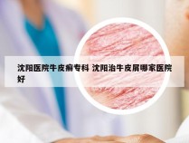 沈阳医院牛皮癣专科 沈阳治牛皮屑哪家医院好