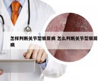 怎样判断关节型银屑病 怎么判断关节型银屑病