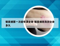 银屑病第一次就布满全身 银屑病初发到全身多久