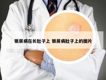 银屑病在长肚子上 银屑病肚子上的图片