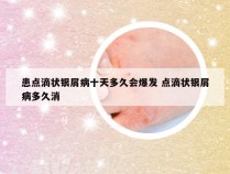 患点滴状银屑病十天多久会爆发 点滴状银屑病多久消