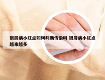 银屑病小红点如何判断传染吗 银屑病小红点越来越多