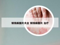 铜钱癣图片大全 铜钱癣图片 治疗