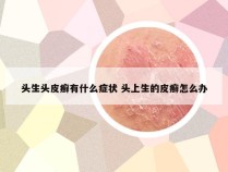 头生头皮癣有什么症状 头上生的皮癣怎么办