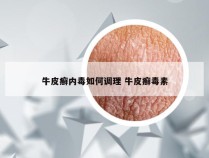 牛皮癣内毒如何调理 牛皮癣毒素
