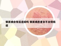 银屑病会有后遗症吗 银屑病患者会不会得癌症