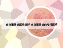 南京银屑病医院哪好 南京银屑病的专科医院