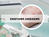 足癣是牛皮癣吗 足癣是皮肤病吗