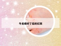 牛皮癣好了后的红斑
