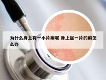 为什么身上有一小片癣呢 身上起一片的癣怎么办