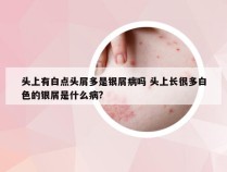 头上有白点头屑多是银屑病吗 头上长很多白色的银屑是什么病?