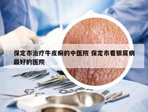 保定市治疗牛皮癣的中医院 保定市看银屑病最好的医院