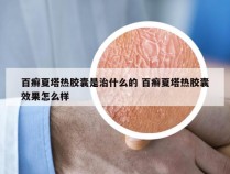 百癣夏塔热胶囊是治什么的 百癣夏塔热胶囊效果怎么样