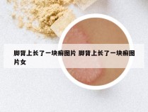 脚背上长了一块癣图片 脚背上长了一块癣图片女