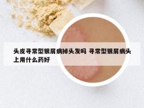 头皮寻常型银屑病掉头发吗 寻常型银屑病头上用什么药好