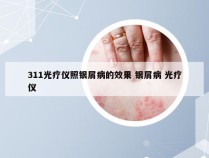 311光疗仪照银屑病的效果 银屑病 光疗仪