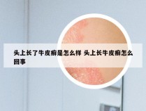 头上长了牛皮癣是怎么样 头上长牛皮癣怎么回事