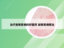 治疗副银屑病的好医院 副银屑病根治