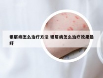 银屑病怎么治疗方法 银屑病怎么治疗效果最好