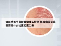 银屑病关节炎需要做什么检查 银屑病关节炎需要做什么检查能查出来