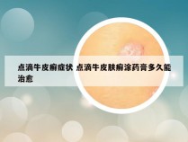 点滴牛皮癣症状 点滴牛皮肤癣涂药膏多久能治愈