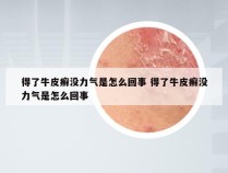 得了牛皮癣没力气是怎么回事 得了牛皮癣没力气是怎么回事
