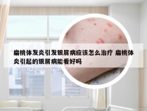 扁桃体发炎引发银屑病应该怎么治疗 扁桃体炎引起的银屑病能看好吗