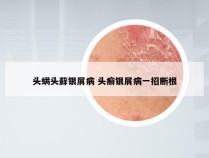 头螨头藓银屑病 头癣银屑病一招断根