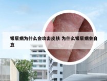 银屑病为什么会攻击皮肤 为什么银屑病会自愈