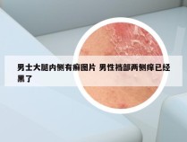 男士大腿内侧有癣图片 男性裆部两侧痒已经黑了