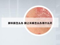 脚长藓怎么办 脚上长癣怎么办用什么药