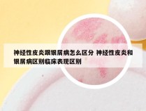 神经性皮炎跟银屑病怎么区分 神经性皮炎和银屑病区别临床表现区别
