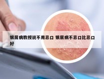 银屑病教授说不用忌口 银屑病不忌口比忌口好